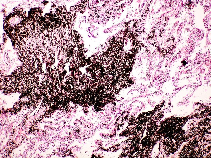 A section of lung tissue from a coal worker, densely blackened and marked with pigmented fibrotic nodules formed around deposited carbon and silica.